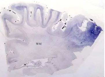 Figure 5: section du cortex cérébral d'un patient  atteint de leucodystrophie (ALD), où il y a une  perte  massive de la myéline au niveau de la SB (WM) laissant  la SB pâlement tachée