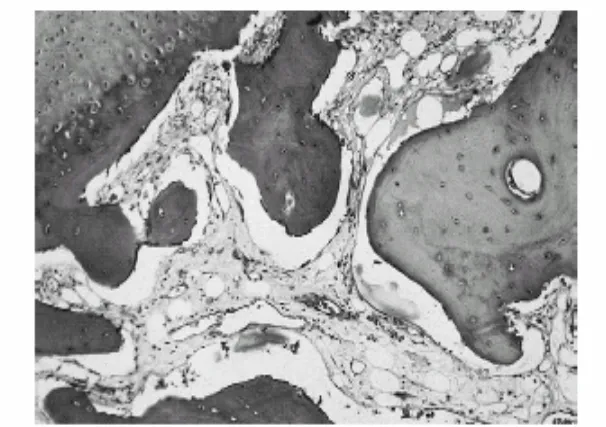 Figure 2 : Enthèse du vaste externe d’un patient atteint de spondylarthrite ankylosante