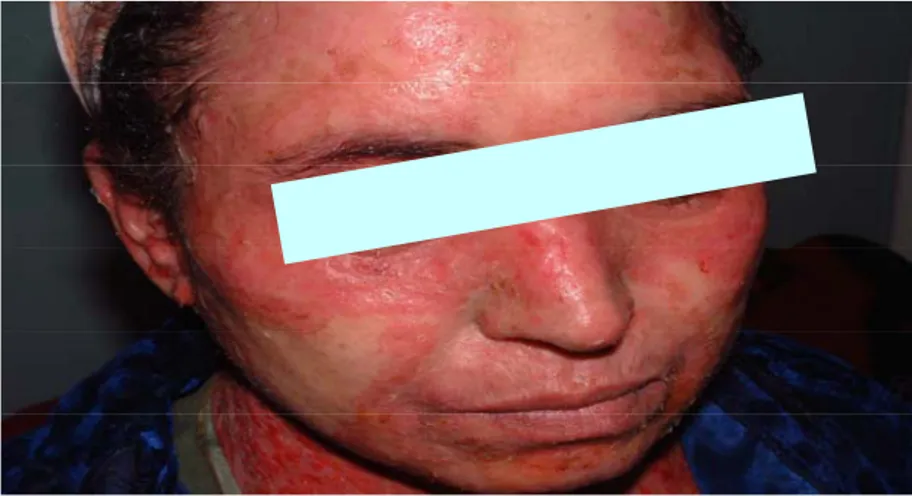 Fig. 6 : Lésions au niveau de la face   au cours d’une surinfection herpétique. 