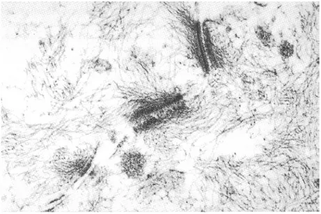 Fig. 8: Marquage des plaques desmosomales par un sérum de pemphigus paranéoplasique  en immunomicroscopie électronique avec marquage à la peroxydase (42)