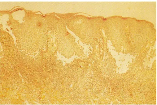 Fig. 10 : L’histologie du pemphigus vulgaire   montrant une acantholyse suprabasale (36)