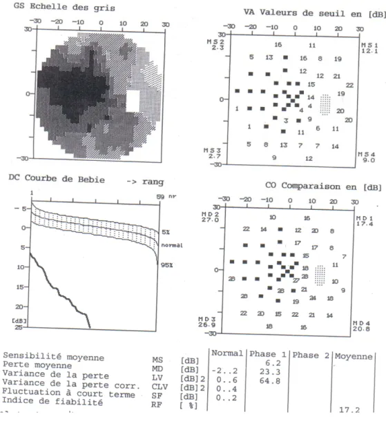 Figure 13 : Champ visuel de l’œil droit du malade  Champ visuel très altéré avec très forte perte de sensibilité 