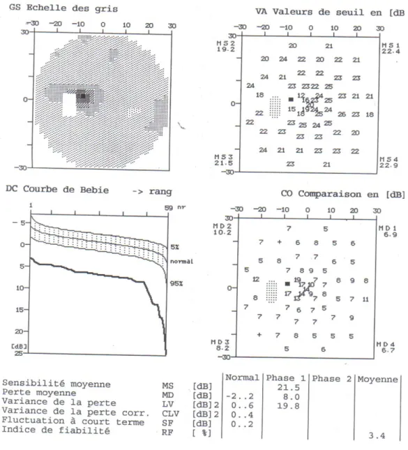 Figure 14 : Champ visuel de l’œil gauche du malade 
