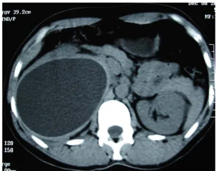 Figure 14 : Un uroscanner mettant en évidence un  KHR droit  type I 