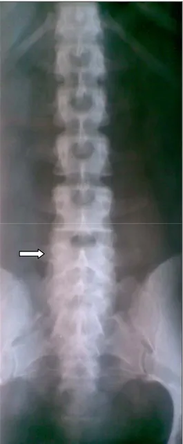 Figure 6 : Radiographie  standard de da face du rachis lombo sacré   montrant une anomalie transitionnelle de la charnière lombosacrée  