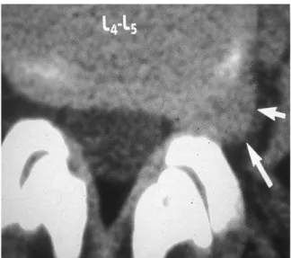 Figure 7 : TDM du rachis lombosacré en coupe axiale   montrant une Hernie discale  L4-L5 extra-foraminale gauche