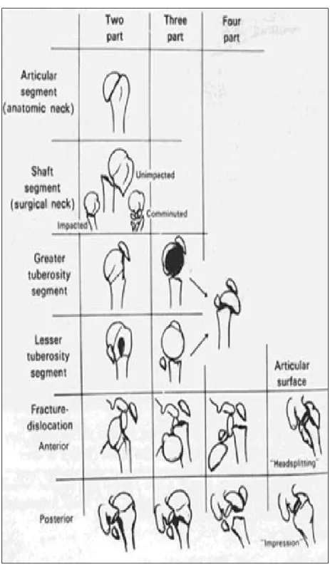 Figure 5: classification de Neer des fractures de l'extrémité supérieure de l'humérus 