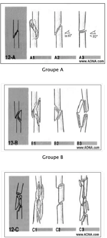 Figure 20: Classification AO des fractures diaphysaires de l'humérus. 