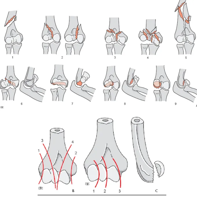 Figure 22: classification de la SOFCOT [68]  A. Principaux traits de fractures anatomiques : 