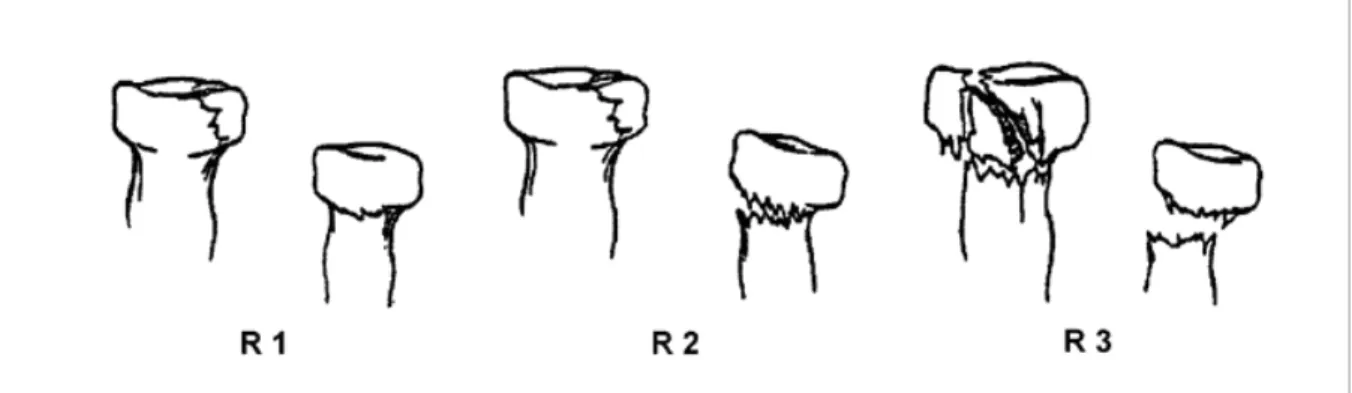 Figure 23: Classification de Mason  modifiée par Morrey  prenant en compte les fractures du col  du radius [79]