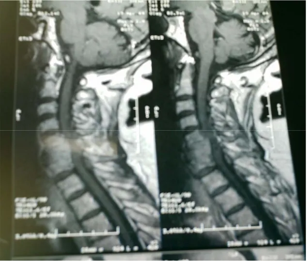 Figure 14: IRM cervico-dorsale, coupes sagittales en séquence pondérées T1 montrant une   compression médullaire secondaire à une atteinte vertébrale bi-étagée C6-C7 en rapport avec 