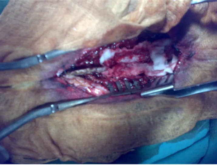 Figure 18 : Vue peropératoire après laminectomie d’une épidurite tumorale responsable d’une  Compression médullaire métastatique d’un adénocarcinome prostatique 