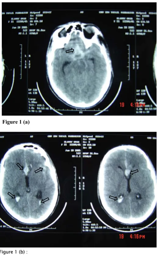 Figure 1 : TDM  cérébrale en coupes axiales objectivant  