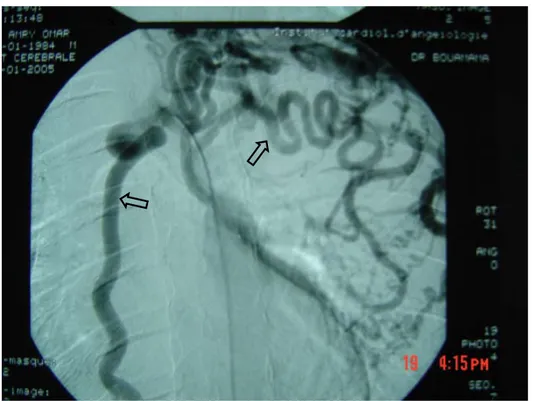 Figure 3 : développement de la circulation collatérale thoracique   avec artère mammaire interne dilatée (a)