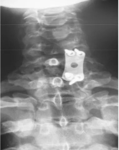 Figure 3 : Radiographie du rachis cervical de  Face    montrant la fixation du rachis par des PRM  