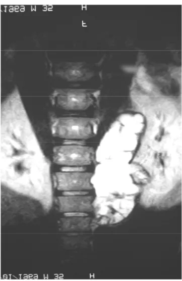 Figure 4: IRM en coupe coronale en séquence T2   montrant une énorme formation  multikystique   en hyper signal latéro vertébrale gauche et rétropéritonéale 