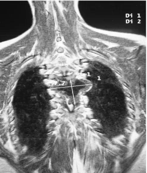 Figure 12 : IRM dorsale ; coupe coronale  en T1   objectivant une lésion en bissac  