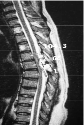 Figure 14 : IRM en coupe sagittale; en T1 après injection de gadolinium:   la même lésion mais qui est hyper intense 