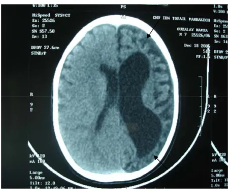 Figure n° 7 : hémi-atrophie cérébrale gauche   chez un patient présentant un syndrome HHE 