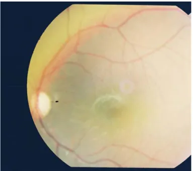 Figure 1 : Atrophie optique de l’oeil droit,   service d’ophtalmologie, CHU Mohamed VI, Marrakech  