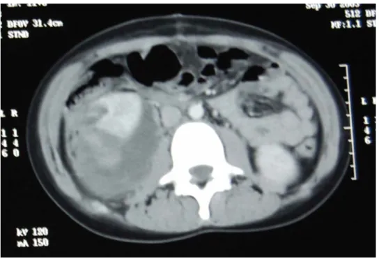 Figure n° 12 : Traumatisme rénal grade IV (NO : 326/03) 