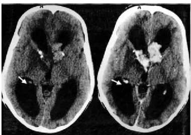 Figure 9 : TDM cérébrale, coupe axiale C–, C+. 