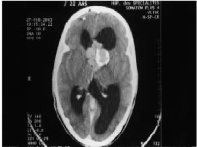 Figure 10 : Scanner cérébral en coupes axiales: 