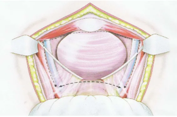 Figure 2: Cystoprostatectomie totale par voie transperitoneale.