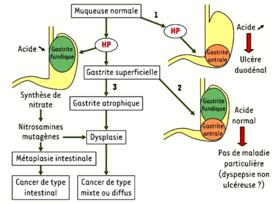 Figure 5 : Schéma physiopathologique de l’implication de HP dans le cancer gastrique (7) 