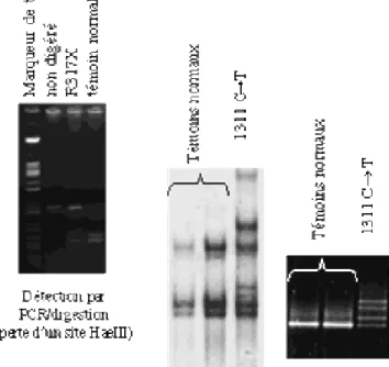 Figure 6 : Mutation non sens de Exon 11 (1311 C&gt;T)   du gène PAX 6 (R317X) (44) 