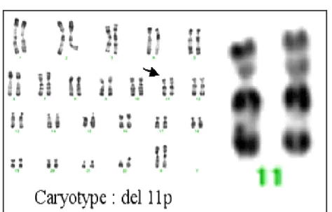 Figure 7 : Caryotype avec délétion du chromosome 11 (del11) (44). 