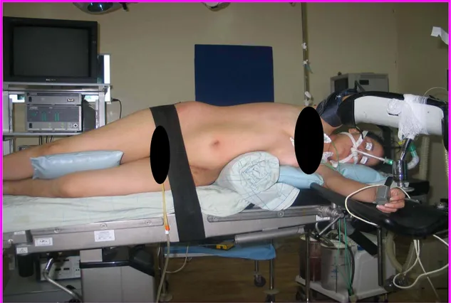 Fig. 13 : Installation d’une patiente en vue d’une néphrectomie droite                                       par voie transpéritonéale 