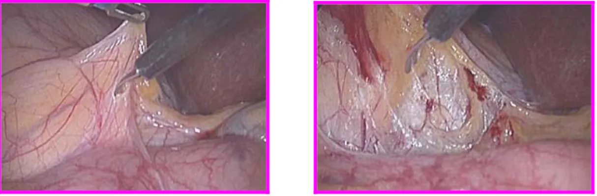 Fig. 18 : Dissection duodéno-colique  ¾  2ème temps : Abord pédiculaire et sa dissection (Fig 19) 