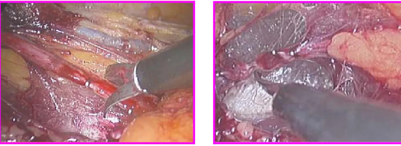 Fig. 22 : L’uretère clippé puis sectionné 