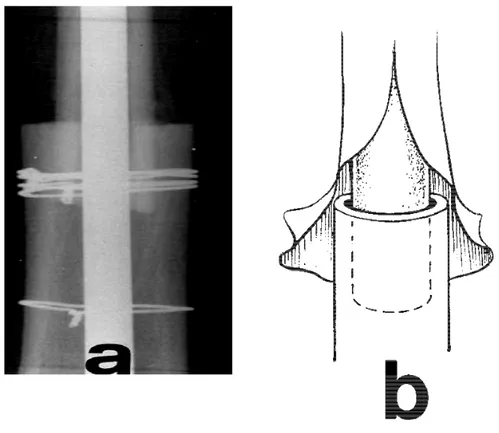 Figure 5 : Radiographie de face d’une jonction fémoro-allogreffe,   avec schéma de la réalisation du télescopage de l’os hôte  