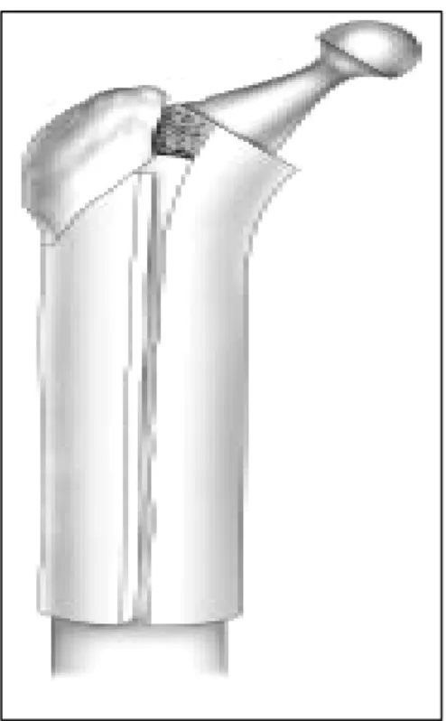 Figure 8 : reconstruction de l’extrémité supérieure du fémur par apposition  externe de greffon, et reprise par prothèse cimentée 