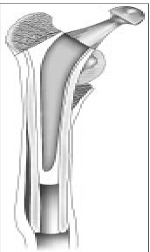 Figure 9 : Technique du double fourreau 