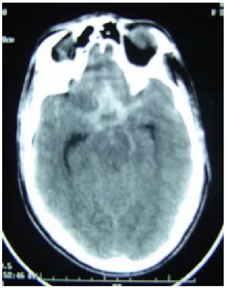 Figure 6a : TDM cérébrale en  coupe axiale, sans injection de produit de contraste  montrant une hémorragie méningée diffuse