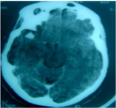 Figure 7 : TDM cérébrale en  coupe axiale, sans injection de produit de contraste  montrant une hémorragie cérébroméningée avec un hématome  