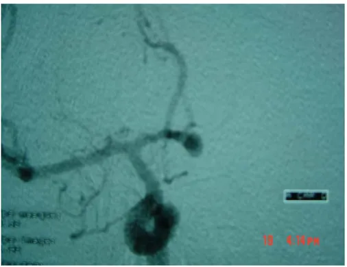 Figure 9 : Artériographie cérébrale face montrant un anévrysme de l’artère  communicante antérieure