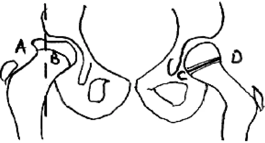 Figure 3: l’excentration céphalique mesurée selon Green 