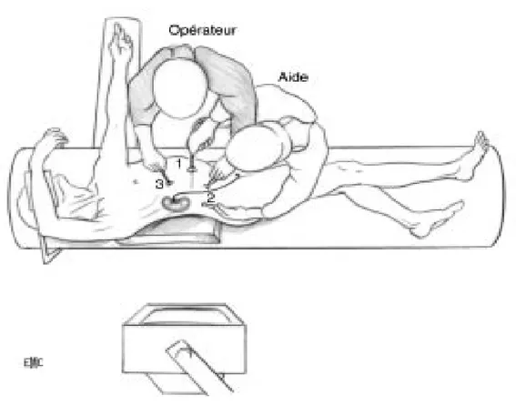 Figure 26 : Installation du patient et mise en place des trocarts   pour une urétérolithotomie abdominale laparoscopique transpéritonéale
