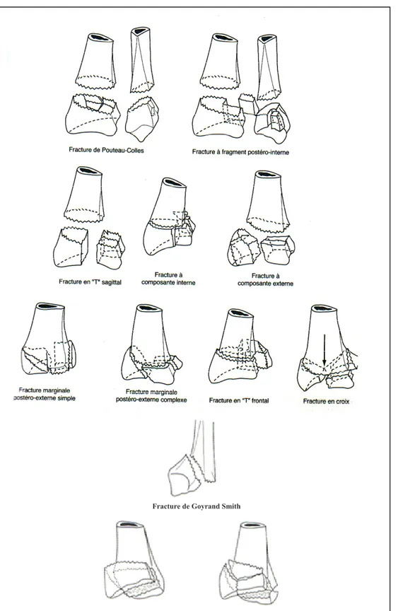 Fig. 6 : Les différents types des fractures distales du radius d’après CASTAING (3) 