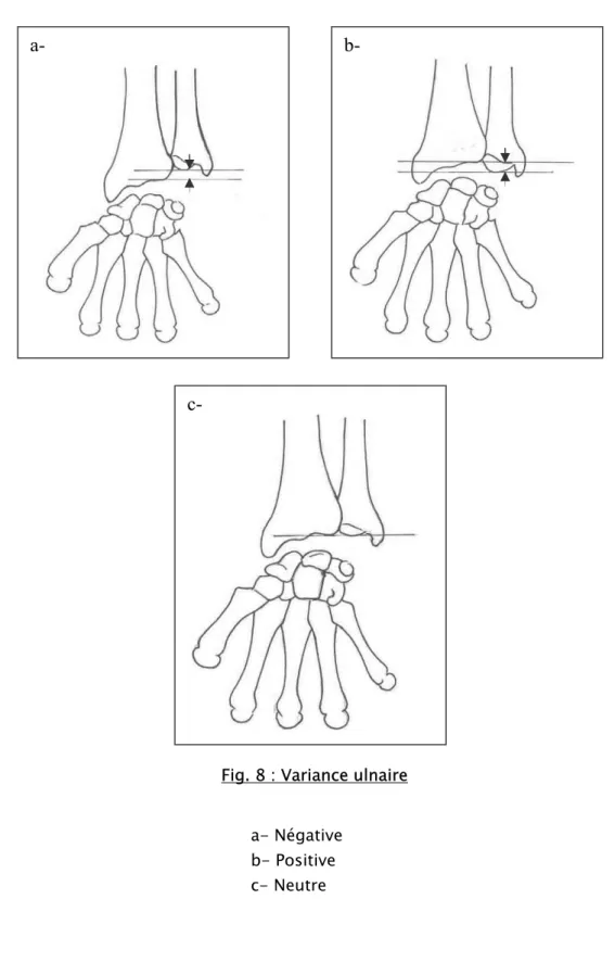 Fig. 8 : Variance ulnaire  a- Négative  b- Positive  c- Neutre a-  b- c- 