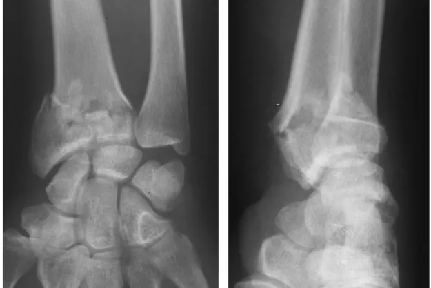 Fig. 14 : Fracture en T sagittal 