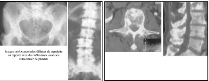 Figure 24 : Aspect radiologique et TDM des métastases osseuses du cancer de la prostate