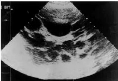 Figure 4 : Image échographique montrant des KH de densité anéchogène,   grossièrement arrondis et multiples occupant presque toute la cavité péritonéale 