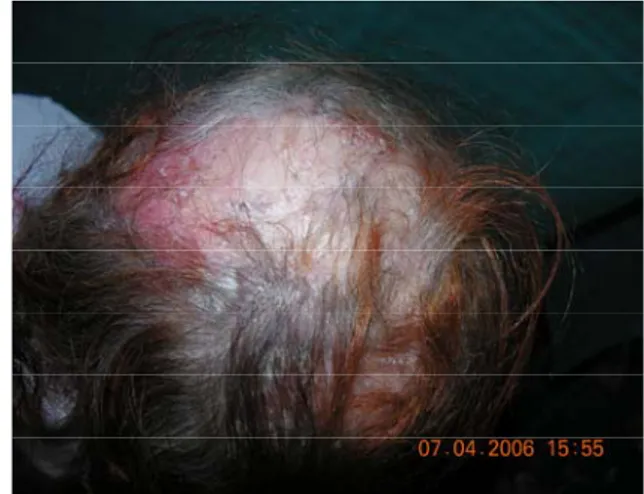 Fig 9. Lupus discoïde de la joue gauche.  Plaque érythémateuse arrondie finement  squameuse avec discrète atrophie centrale