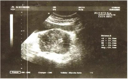 Figure 1 : Aspect d’un utérus polymyomateux (cas 2) 
