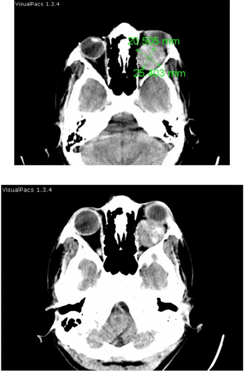 Figure 14: TDM crânio-cérébrale: coupes axiales en fenêtre  parenchymateuse sans injection du produit de contraste 